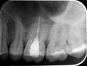 RETROALVEOLARNI